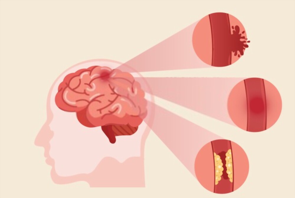 Quick Life-saving Test For Stroke