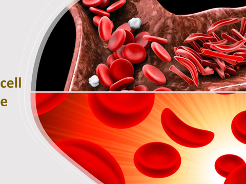 Gene Therapy Technology For Sickle-cell Disease Treatment