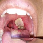 Things You Need To Know About Diphtheria