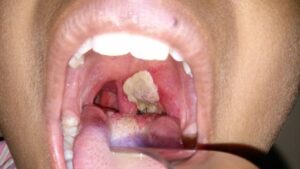 Things You Need To Know About Diphtheria