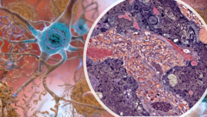 A Rare Genetic Mutation Could Delay The Onset Of Alzheimer’s
