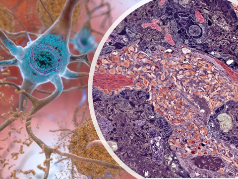 A Rare Genetic Mutation Could Delay The Onset Of Alzheimer’s