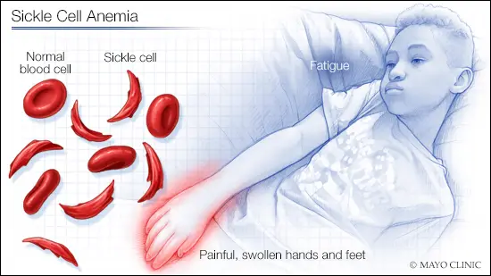 Sickle Cell Disorder All You Need To Know About It