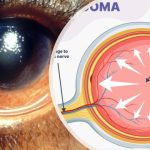 Genetic Revelation Of Glaucoma Risk Factors In People Of African Descent