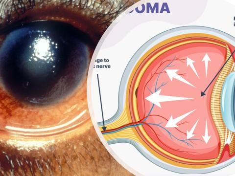 Genetic Revelation Of Glaucoma Risk Factors In People Of African Descent