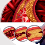 Gut Bacteria Could Checkmate Cardiovascular Diseases By Reducing Cholesterol Levels In Blood 