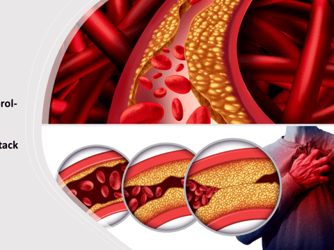 Gut Bacteria Could Checkmate Cardiovascular Diseases By Reducing Cholesterol Levels In Blood 
