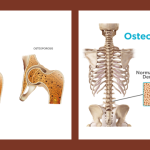 Lactation Hormone May Be Key To Osteoporosis Treatment