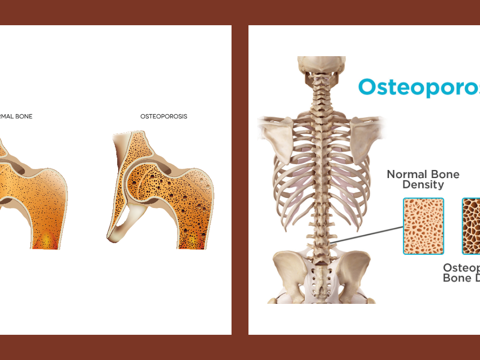 Lactation Hormone May Be Key To Osteoporosis Treatment