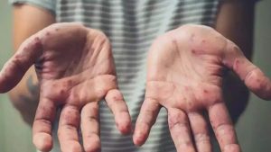 WHO Declares Mpox Global Public Health Emergency, As Sweden Confirms First Case