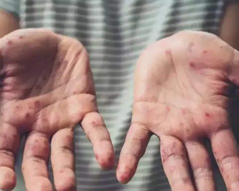 WHO Declares Mpox Global Public Health Emergency, As Sweden Confirms First Case