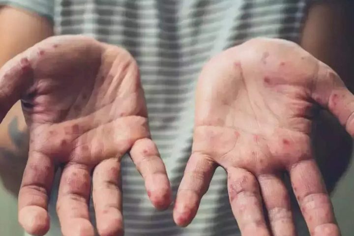 WHO Declares Mpox Global Public Health Emergency, As Sweden Confirms First Case