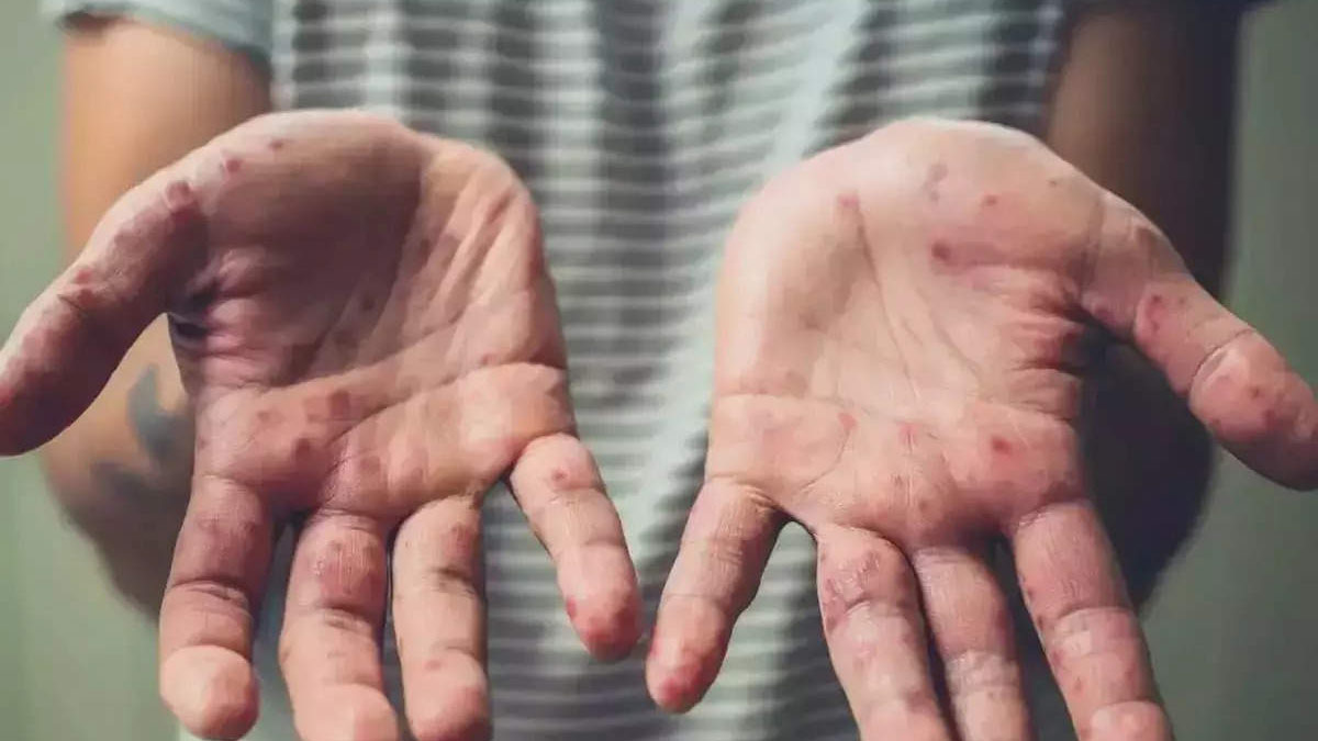 WHO Declares Mpox Global Public Health Emergency, As Sweden Confirms First Case