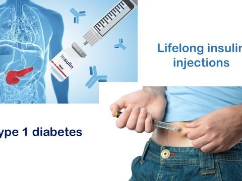 Type 1 Diabetes: Zimislecel Stem Cell Therapy To The Rescue