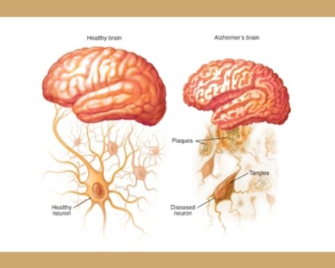 Lithium Deficiency Could Hold The Key To Alzheimer’s Disease