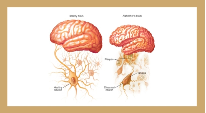 Lithium Deficiency Could Hold The Key To Alzheimer’s Disease